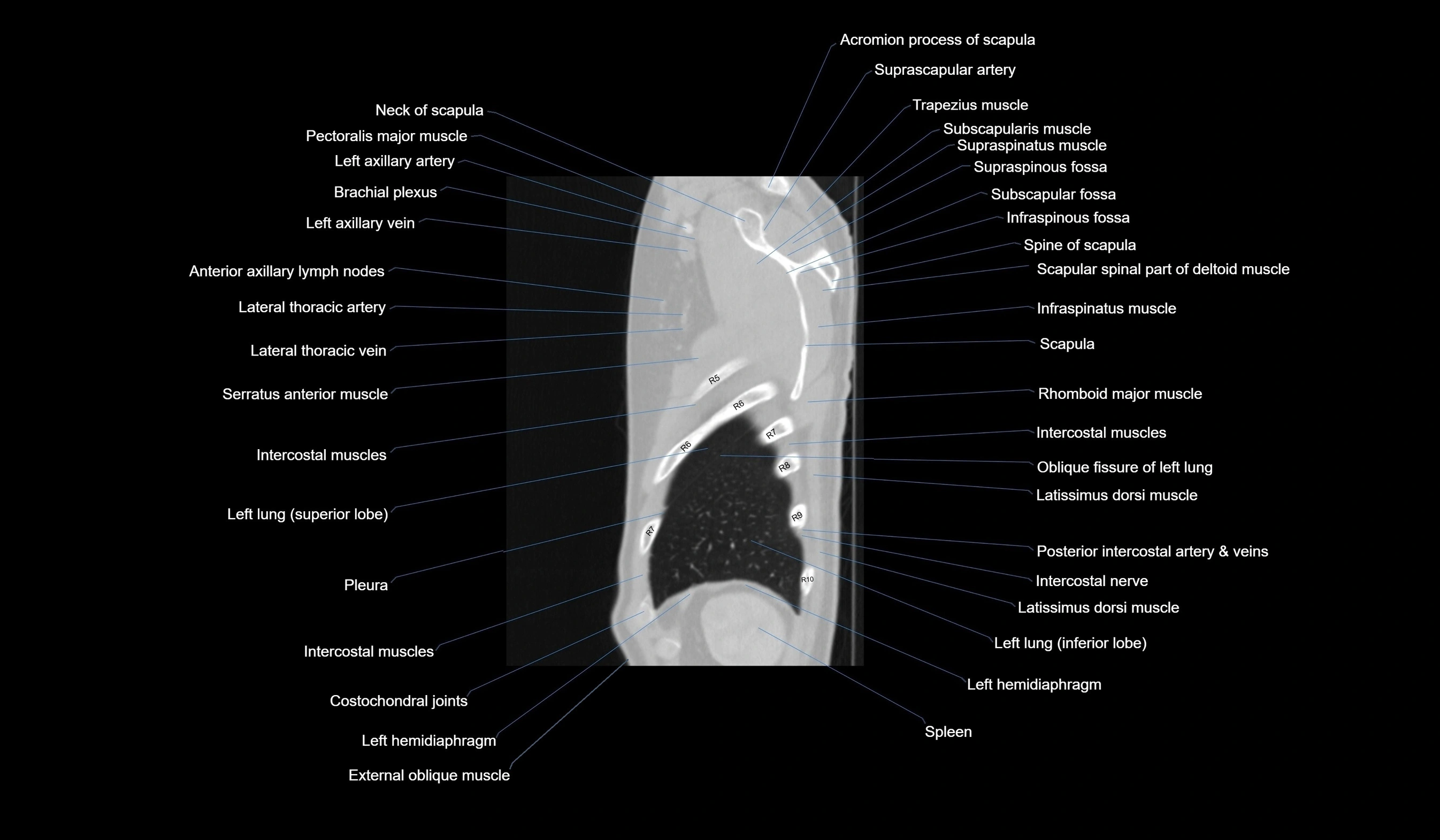 CT chest (thorax) labelled sagittal cross sectional anatomy radiology image-00128.webp